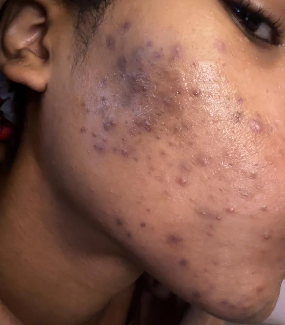 1. The Acne Healed. The Dark Marks Didn’t.
